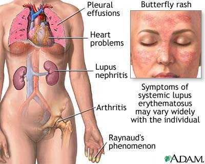 turmeric for lupus