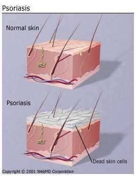 Turmeric for Psoriasis