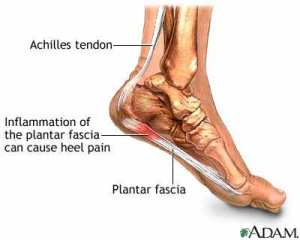 Using Turmeric for Plantar Fasciitis