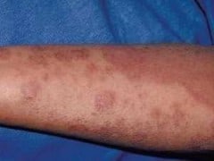 Turmeric For Eczema And Itching Turmeric For Eczema And Itching