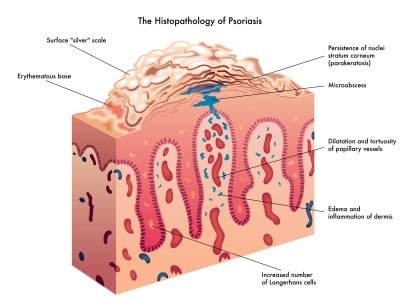 Effect of steroids